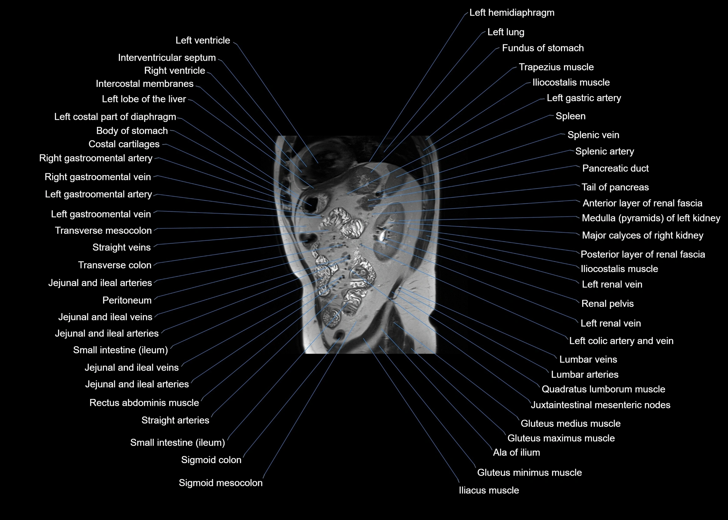 MRI abdomen sagittal cross sectional anatomy  radiology  image-img-00001-00049.webp